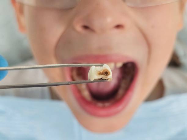 Best Pediatric Emergency Dentist in Parker City, IN